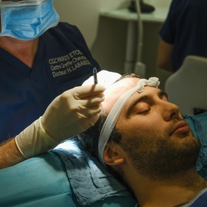 Implants capillaires FUE