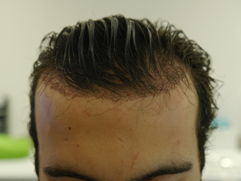 Greffe de cheveux Paris