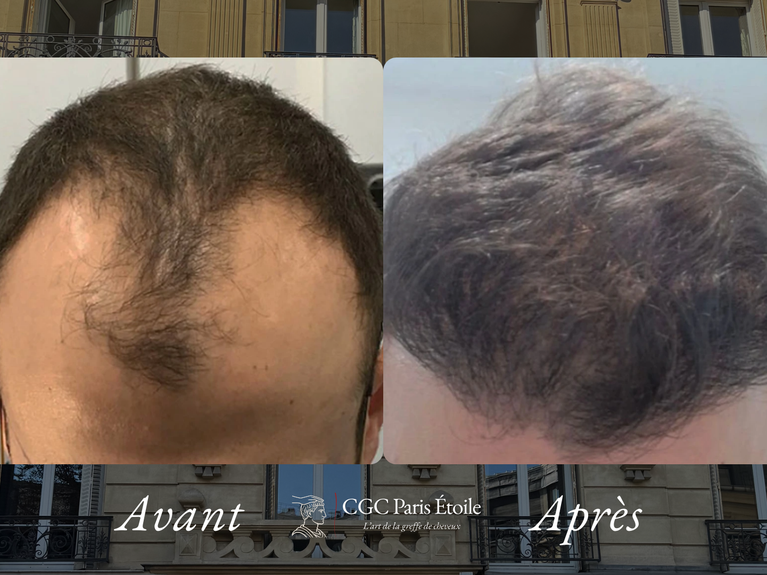 Greffe de cheveux Paris